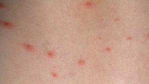 HIQA asks Irish parents to have their say on adding chicken pox jab to vaccine schedule