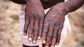 'An extraordinary situation' - WHO declares monkeypox a global health emergency