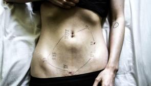 Explainer: What is endometriosis? A debilitating condition often dismissed