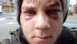 Fundraiser launched for Croatian man left with brain bleed after friend killed in Dublin assault