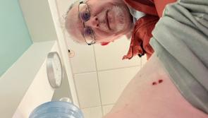 TD bitten by dog while out canvassing for election shares update