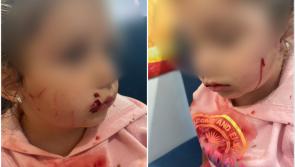 'We're in shock' - Horror cat attack in Longford leaves 3 year-old girl scarred