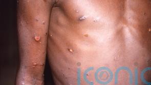 97 cases of monkeypox confirmed in Ireland