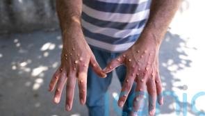 Advisory group on monkeypox will bring additional governance &ndash; CMO