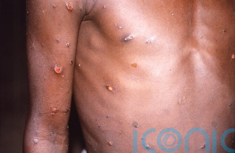 HSE widening rollout of monkeypox vaccine to people at high risk