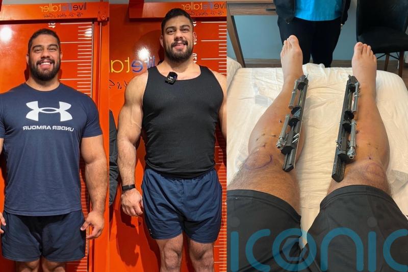 Dad of two spends &euro;100k lengthening his limbs to increase height from 6ft to 6ft 7in